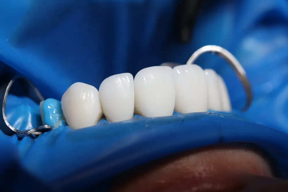 Traditional Acrylic Full and Partial Dentures