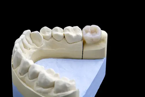 IPS e.max® (Lithium Disilicate)