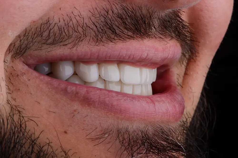 High-Translucency Monolithic Zirconia