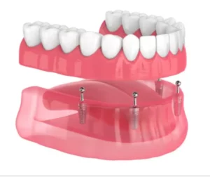 Implant Retained Denture