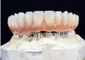 Implant Retained Hybrid