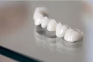 Traditional Pfm (porcelain Fused To Metal)