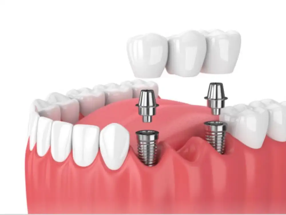 Dental Implants