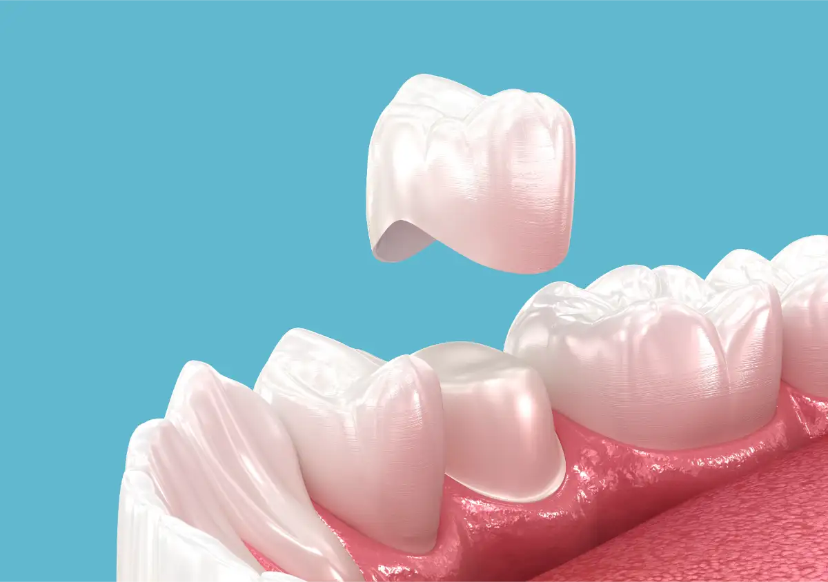 Tooth Crown Model